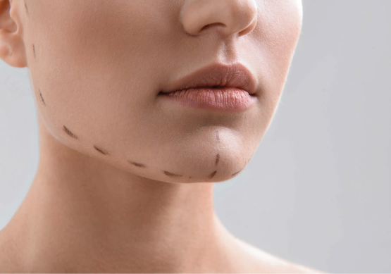 Chin Augmentation