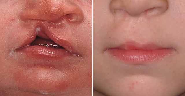 Cleft Lip 