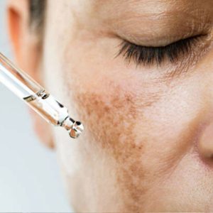 Melasma Treatment
