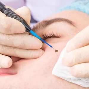 Mole Removal